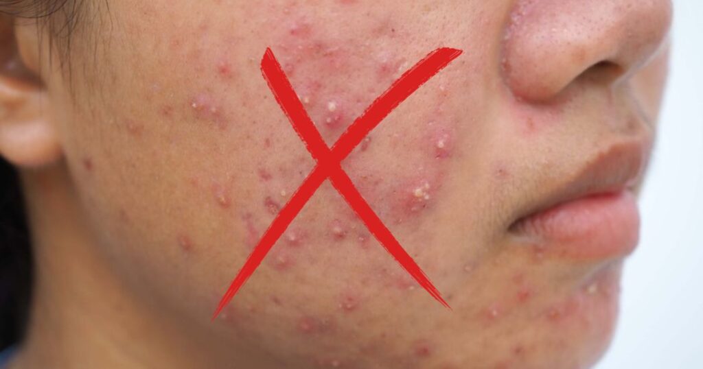 don't use pimle patches on this type of acne