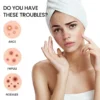 Invisible pimple patch applied on face – acne treatment patch in use