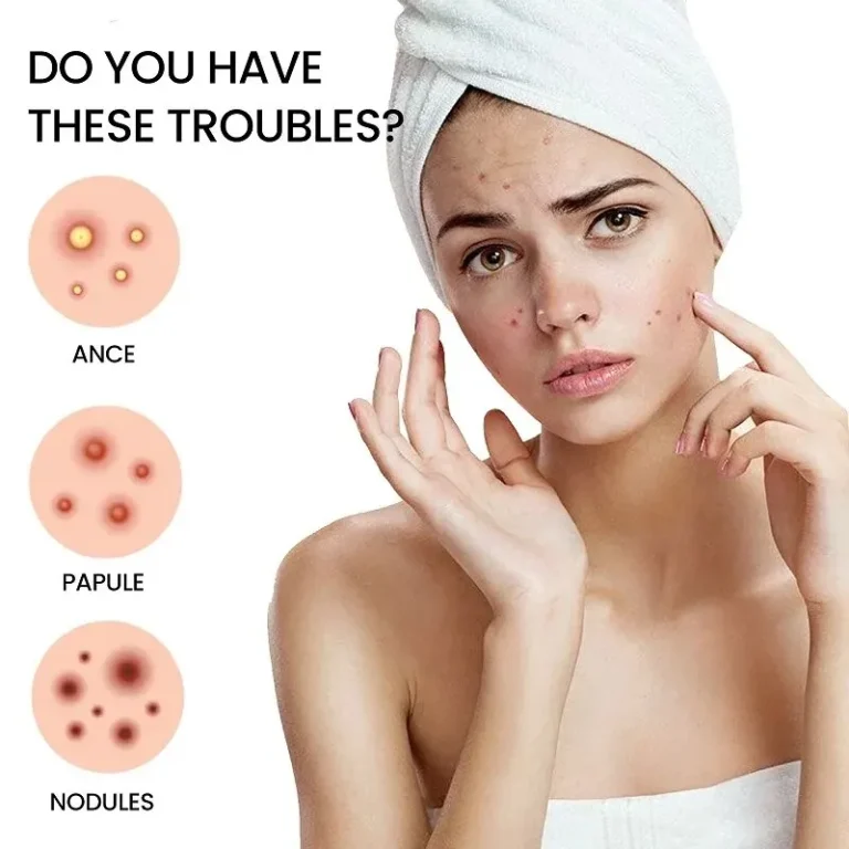 Invisible pimple patch applied on face – acne treatment patch in use